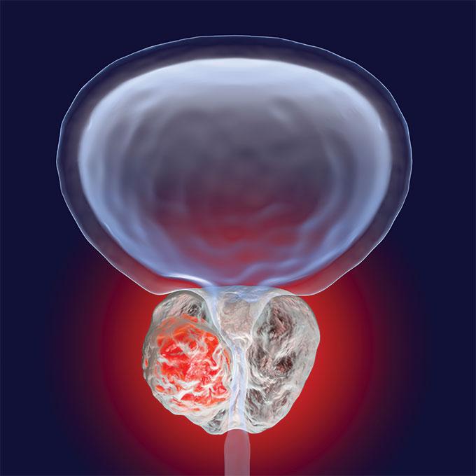 prostate cancer illustration