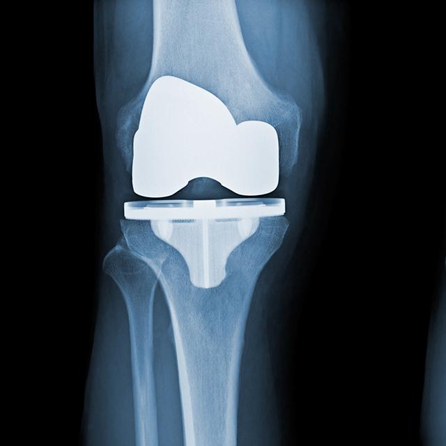After X-rays of a total knee replacement