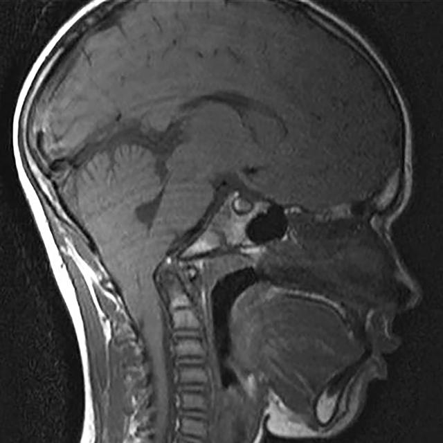 An MRI image shows a large Chiari malformation