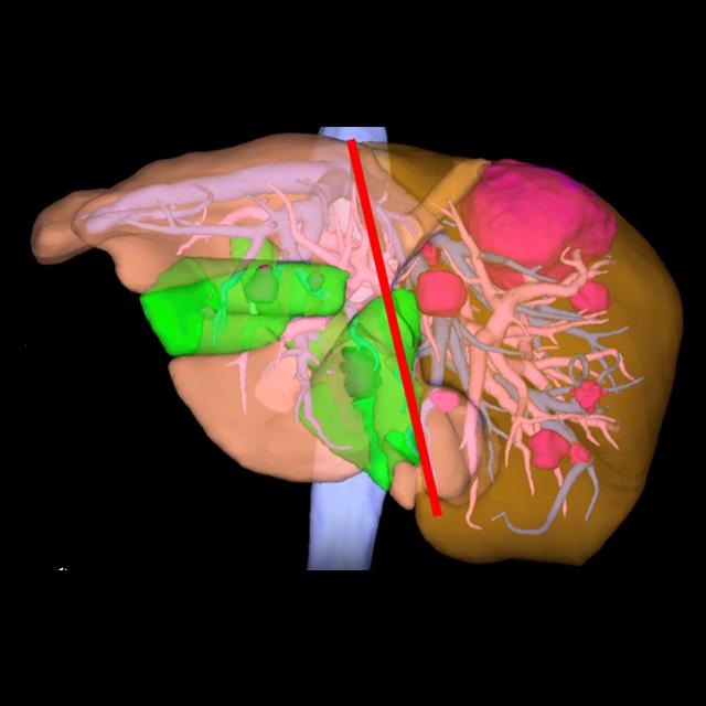 A 3D image shows before and after renderings of the liver of a patient undergoing an ALPPS operation.