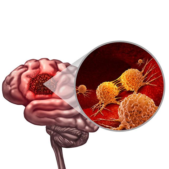 A medical illustration of brain cancer